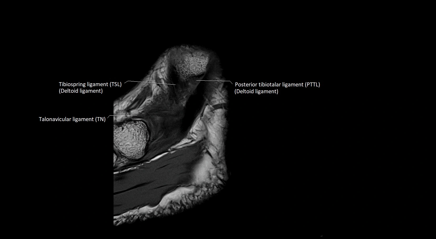 MRI ankle ligaments anatomy sagittal 3T image 2.webp